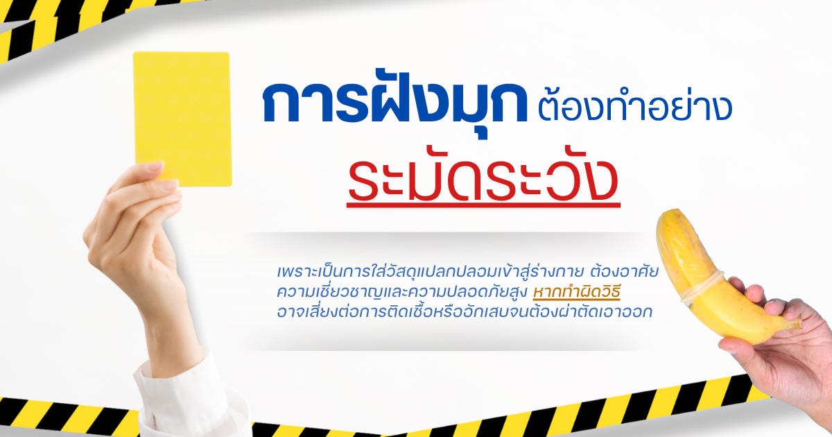 การฝังมุก