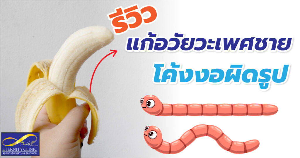 Review Fixing a curved penis - eternityclinicdoctorbeer อวัยวะเพศงอ