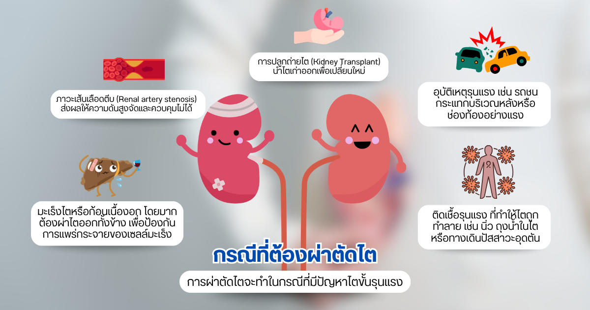 ผ่าตัดไต