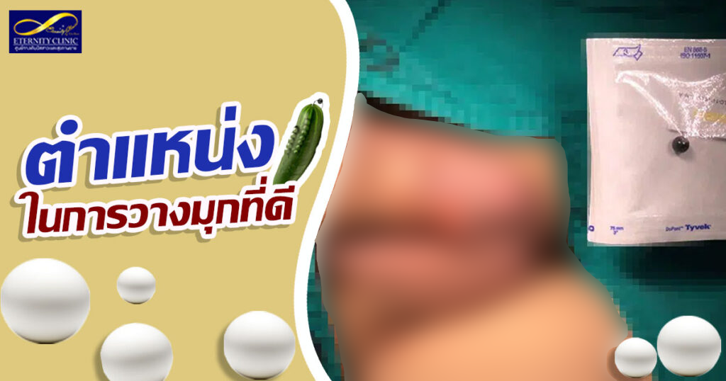 เบลอรูปภาพ1 - eternityclinicdoctorbeer