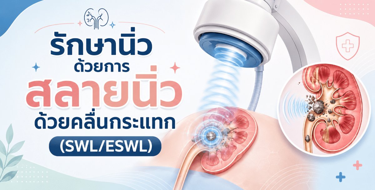 รักษานิ่วด้วยการสลายนิ่วด้วยคลื่นกระแทก (SWL/ESWL)