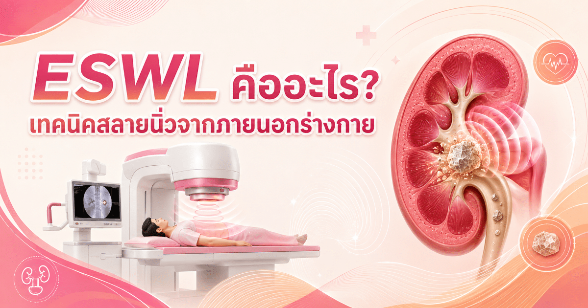 ESWL คืออะไร? เทคนิคสลายนิ่วจากภายนอกร่างกาย