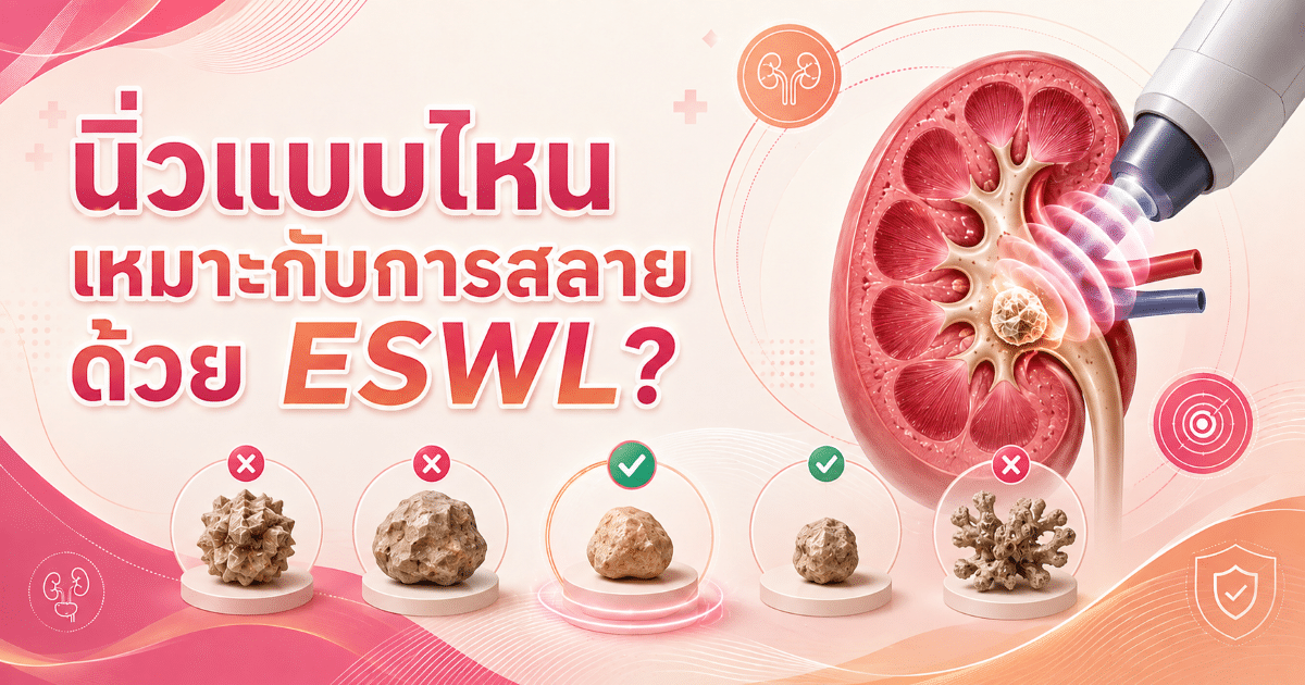 นิ่วแบบไหนเหมาะกับการสลายด้วย ESWL?
