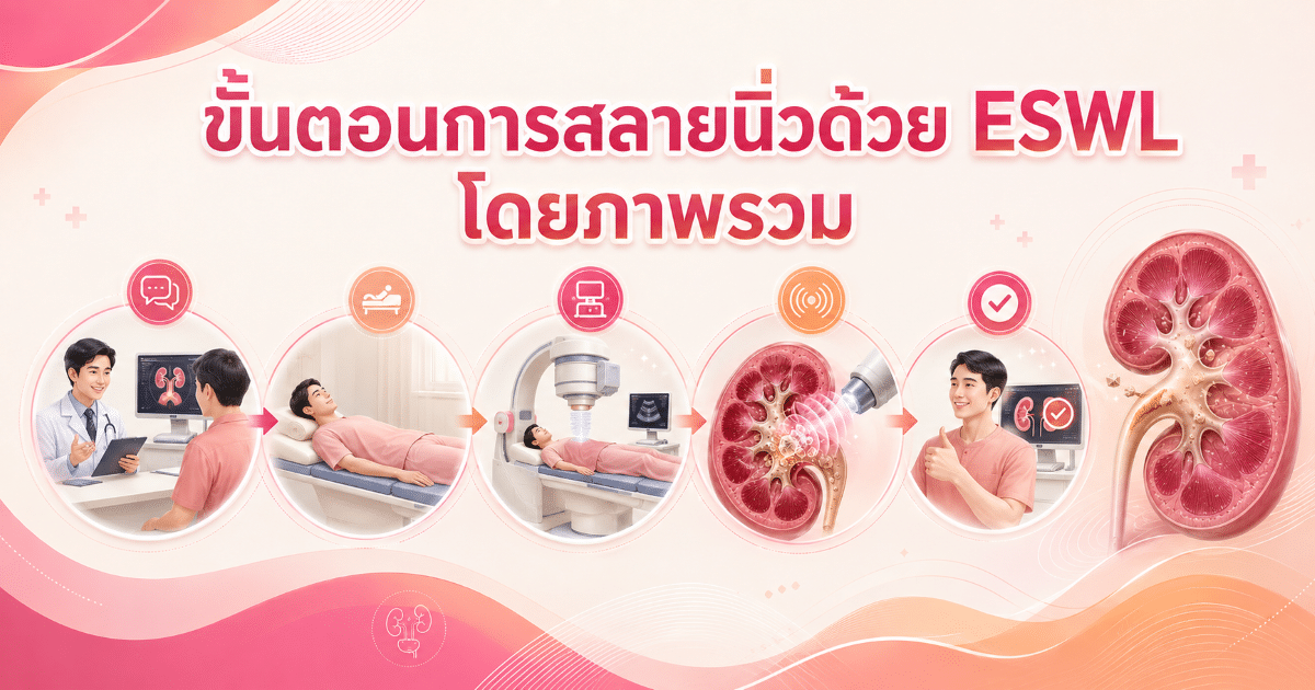 ขั้นตอนการสลายนิ่วด้วย ESWL โดยภาพรวม