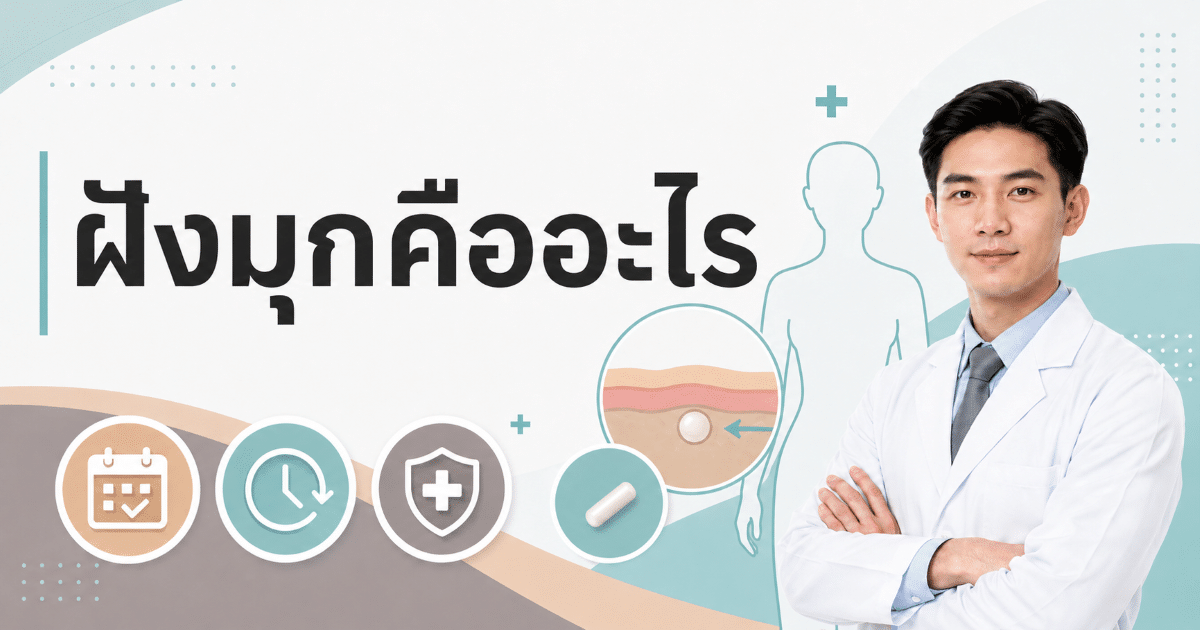 ฝังมุกคืออะไร